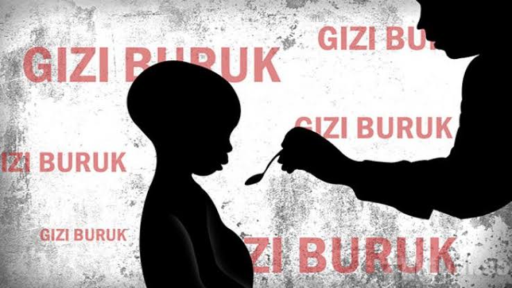 Duh! Ada 241 Kasus Gizi Buruk di Cianjur Selama Pandemi, Tiga di Antaranya Meninggal